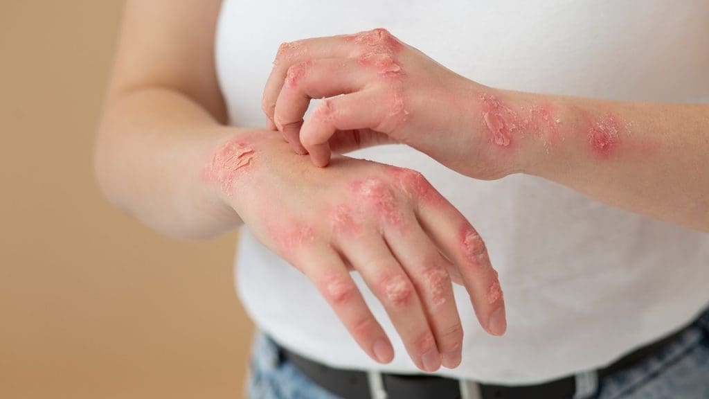 Skin Rash and Redness in GVHD Skin Rash and Redness in GVHD