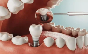 How to Get a Bone Graft for Implant: Step-by-Step Guide for Dental Implants
