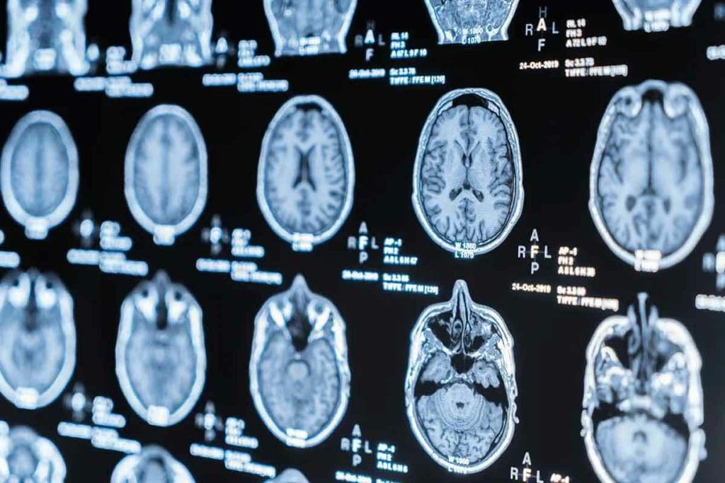 Do MRIs Show Broken Bones That X-Ray Cannot?