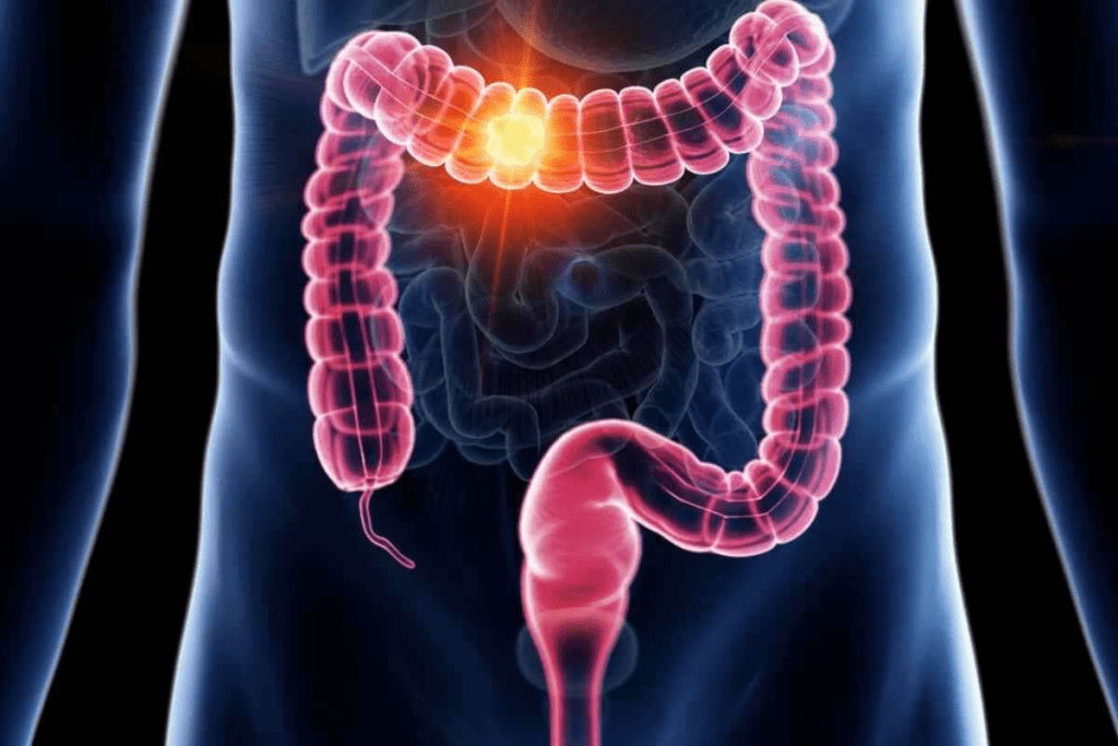 Does a PET Scan Show Colon Cancer Accurately?