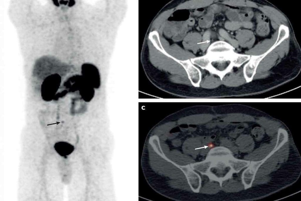 Difference In PET Scan And CT Scan: 7 Crucial Facts for Cancer