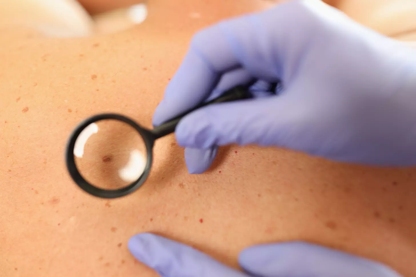 8 Effective Skin Cancer Removal Surgeries: Types, Steps & What to Expect