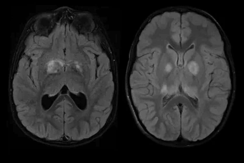 Brain Tumor Treatment Without Surgery: 7 Options