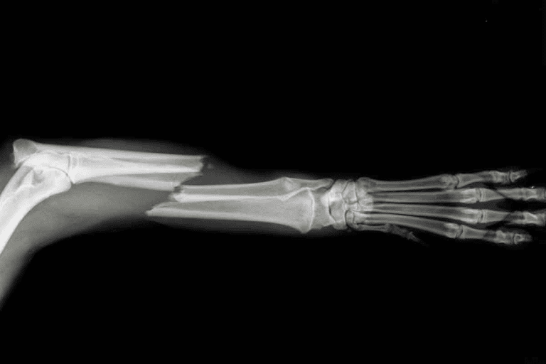 Will an MRI Show Broken Bones That X-Ray Cannot?