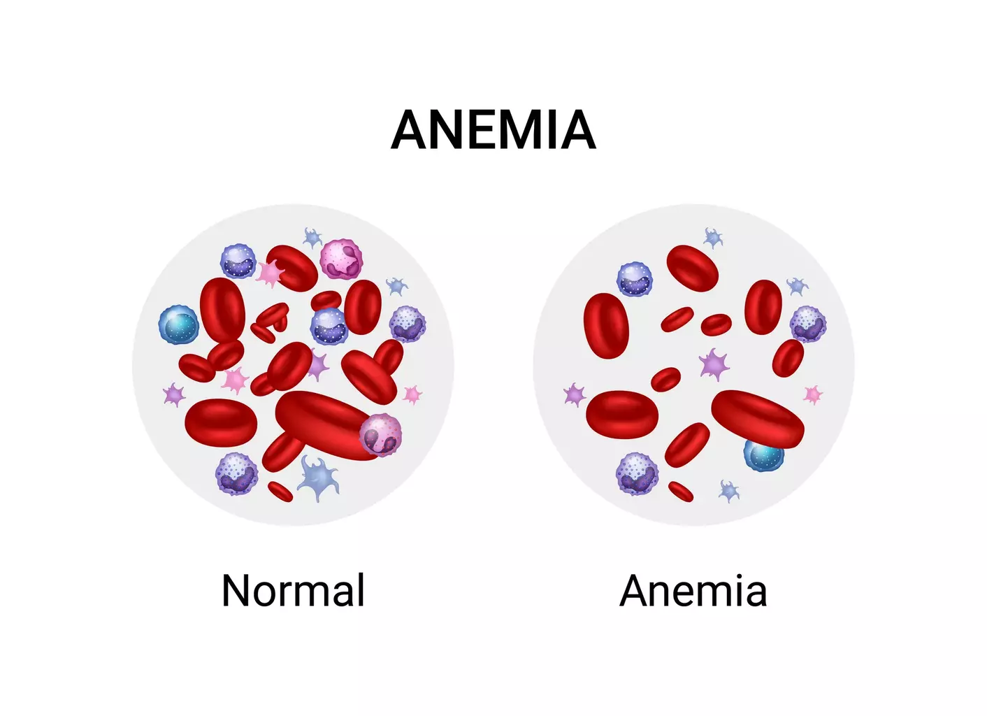 Which Type of Anemia Is Caused by Bone Marrow Failure and What Is Aplastic Anemia?