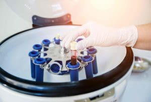 How to Navigate the Autologous Stem Cell Transplant Process for Multiple Myeloma