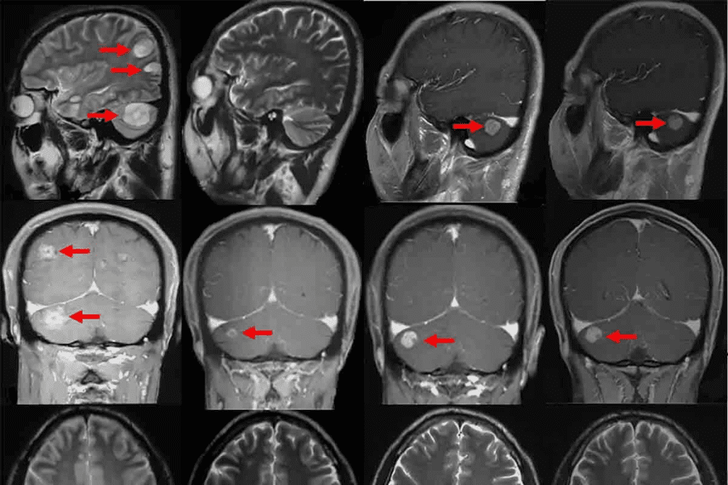 Does an MRI Show Tumors Effectively?