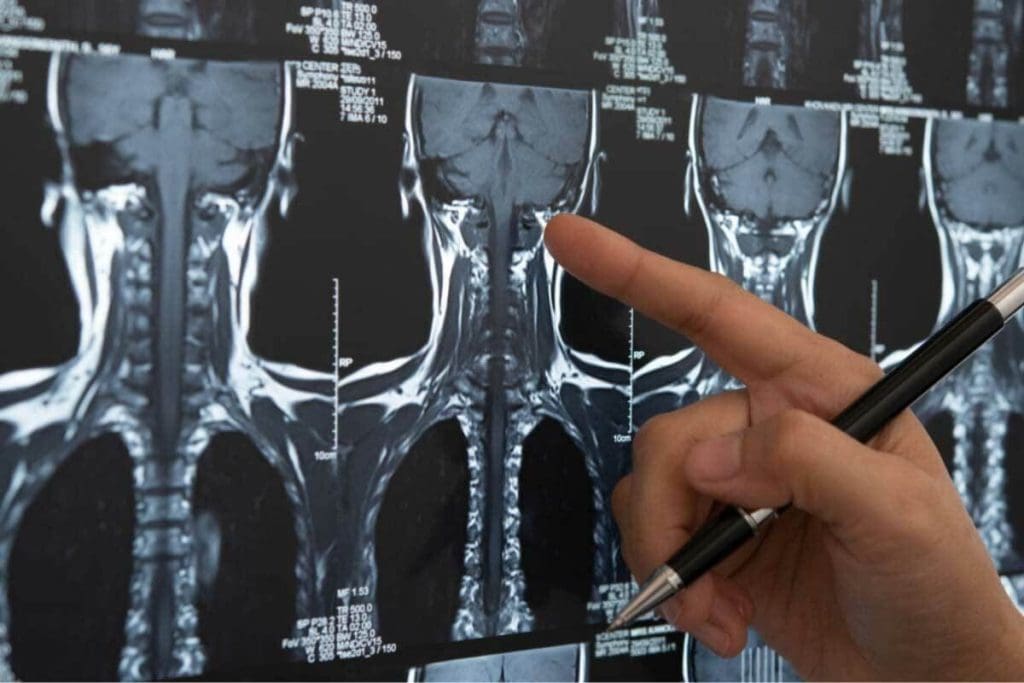 Xray of Brain Tumor: 5 Key Facts