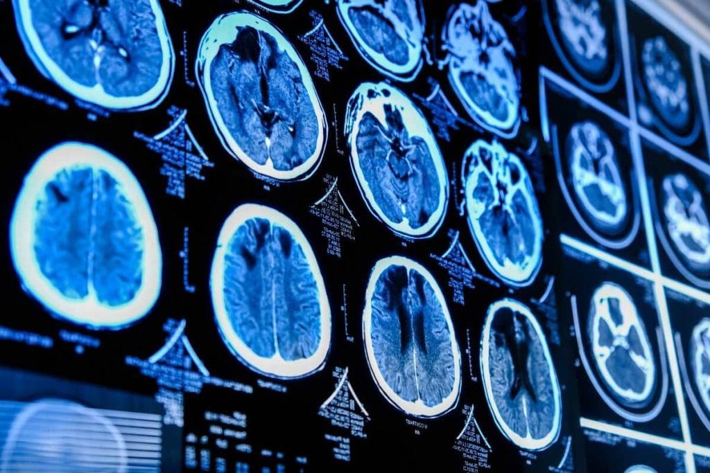 Xray of Brain Tumor: 5 Key Facts