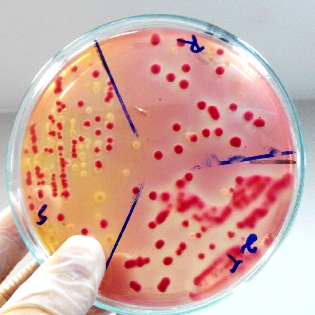 What Food is Good for MDS? A Patient Nutrition Guide 1 cropped hand scientist holding agar plate with blood laboratory LIV Hospital