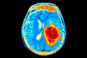 Brain Cancer MRI: 10 Key Facts