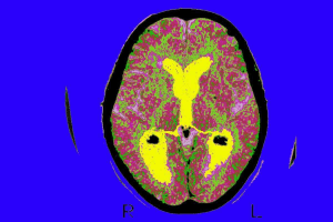 Brain CT Scan or MRI: Which Is Better for Tumor Detection?