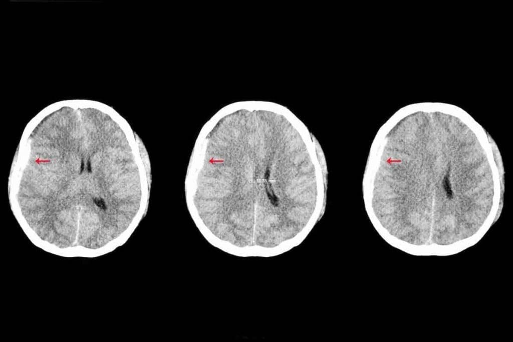 How Accurate Is CT Scan for Brain Tumor? 1 How Accurate Is CT Scan for Brain Tumor?