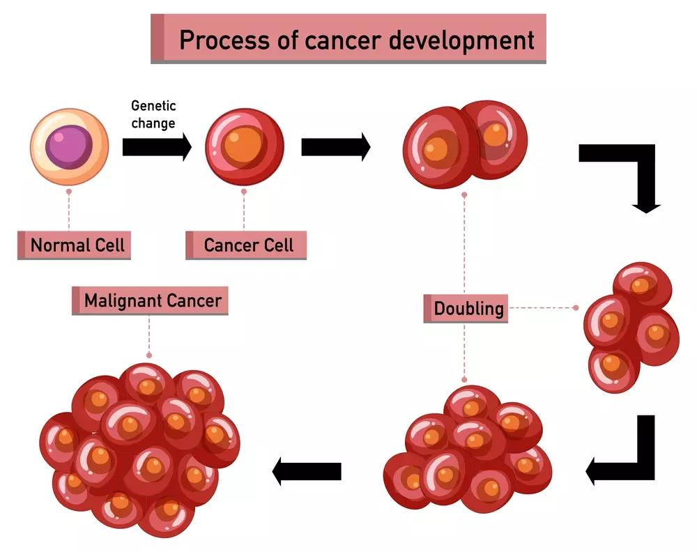 Acute Myeloid Leukemia, a hematological malignancy characterized by the rapid proliferation of immature myeloid cells in the bone marrow. In the foreground, a detailed illustration depicts the abnormal cells, their irregular shapes, and the disruption of normal blood cell production. The middle ground showcases the impact on the circulatory system, with blood vessels and organs affected by the disease. In the background, a somber, muted palette conveys the gravity of the condition, while subtle lighting emphasizes the complexity and severity of Acute Myeloid Leukemia. The overall composition evokes a sense of urgency and the need for deeper understanding of this challenging form of blood cancer. Acute Myeloid Leukemia, a hematological malignancy characterized by the rapid proliferation of immature myeloid cells in the bone marrow. In the foreground, a detailed illustration depicts the abnormal cells, their irregular shapes, and the disruption of normal blood cell production. The middle ground showcases the impact on the circulatory system, with blood vessels and organs affected by the disease. In the background, a somber, muted palette conveys the gravity of the condition, while subtle lighting emphasizes the complexity and severity of Acute Myeloid Leukemia. The overall composition evokes a sense of urgency and the need for deeper understanding of this challenging form of blood cancer.