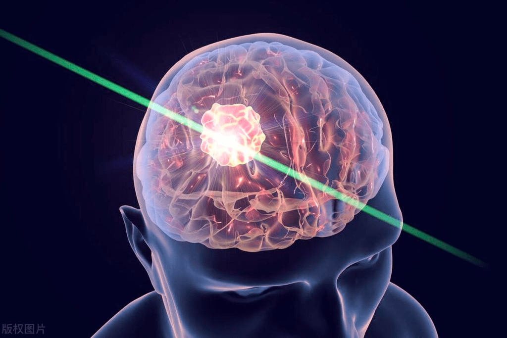 Brain Tumor Biopsy: 7 Key Facts