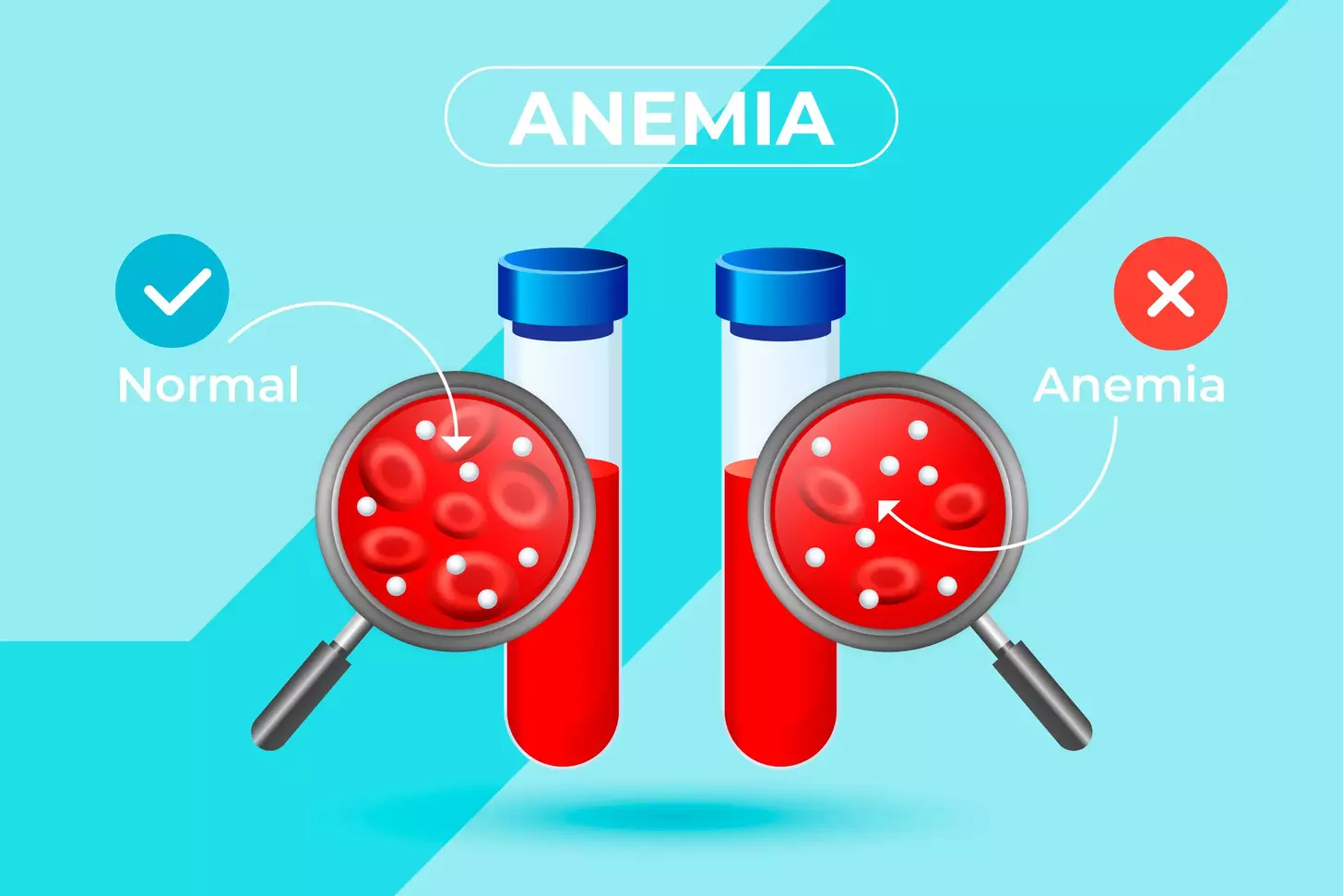 Aplastic anemia