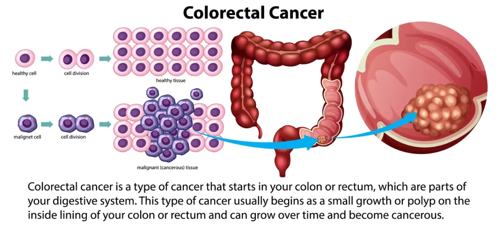 Understanding Colorectal Cancer Understanding Colorectal Cancer