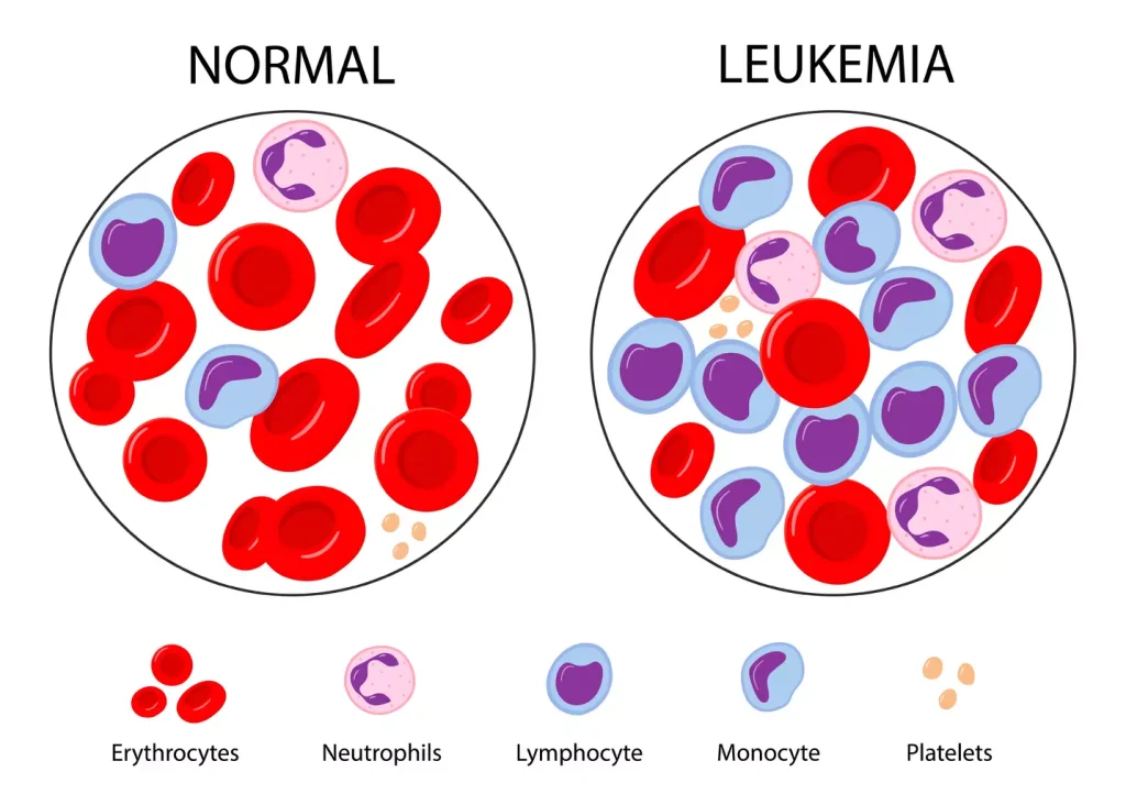 Acute Myeloid Leukemia (AML)