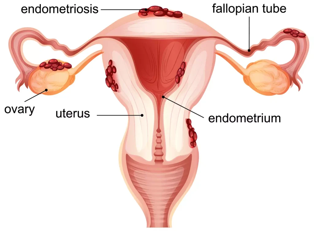 A detailed cross-section of the human cervix, magnified to reveal the cellular structures affected by an aggressive HPV infection. The foreground depicts the abnormal growths and lesions on the cervical tissue, with intricate patterns of dysplastic cells and disorganized cell division. The middle ground showcases the underlying blood vessels and connective tissue, while the background subtly fades into a muted, anatomical representation of the female reproductive system. The lighting is soft and naturalistic, with a clinical, yet informative atmosphere, allowing the viewer to clearly observe the pathological changes associated with cervical cancer.