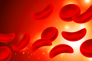 Sickle Cell Disease What Is "“ Risks Explained