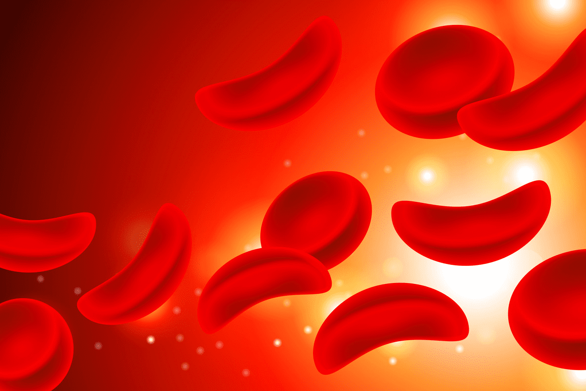 Sickle Cell Disease What Is "“ Risks Explained
