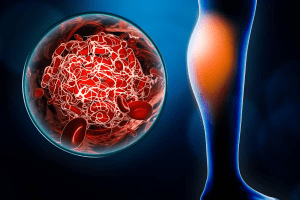 Blood Clot Treatment: Ultimate & Powerful Guide