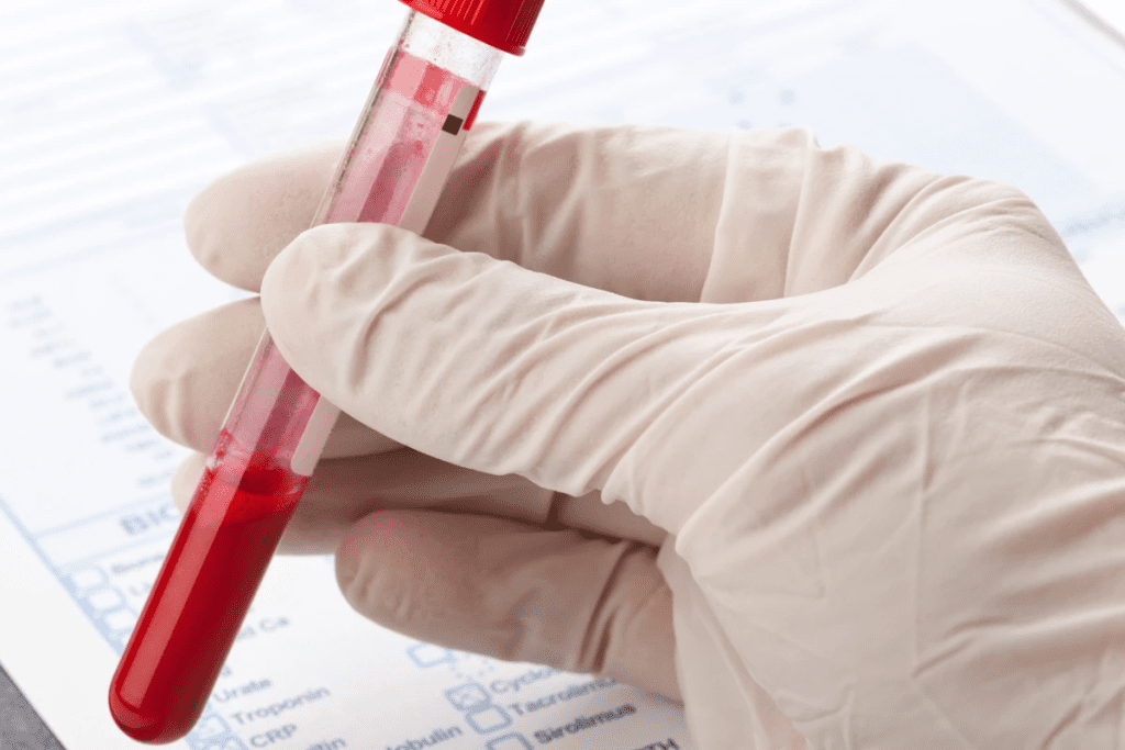 Causes of Autoimmune Diseases: Triggers