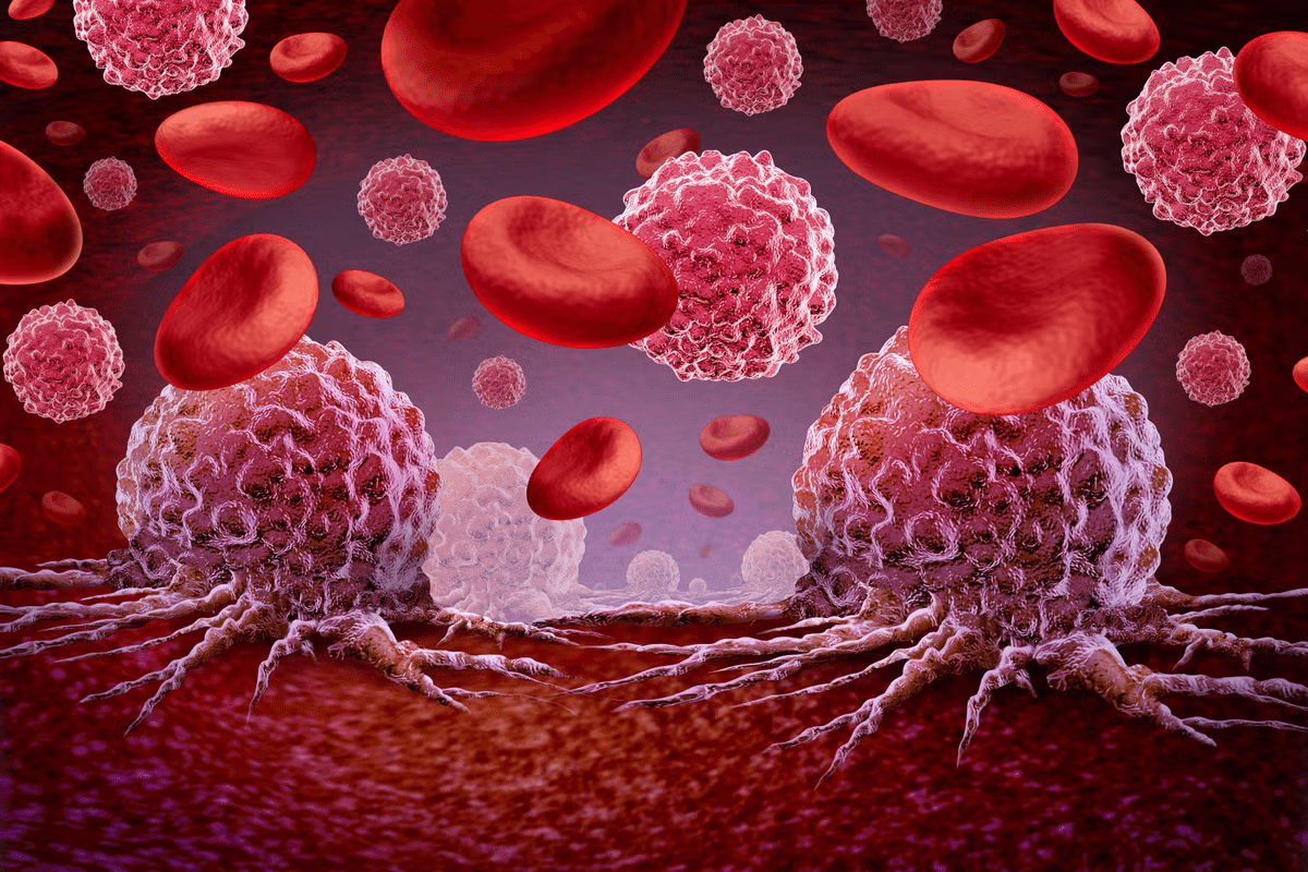 Types of Blood Cancer: Most Curable Forms