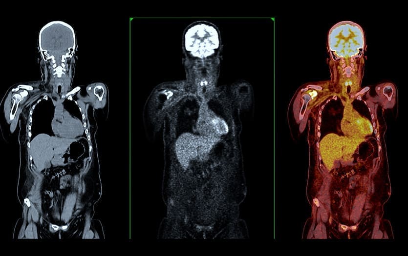 What Color Does Cancer Show Up On A PET Scan? 2 Dashboard 835 Imaging HW 03 25 LIV Hospital