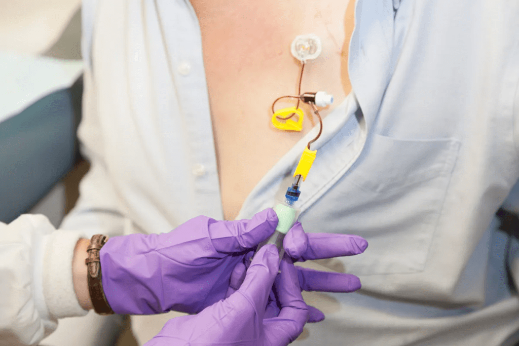 Understanding where chemo port goes in the body