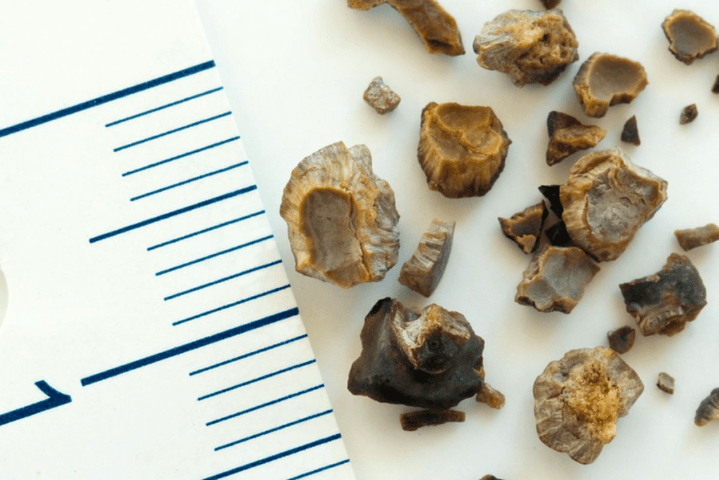 How to Prevent Kidney Stones: Top 7 Proven Vitamins You Need