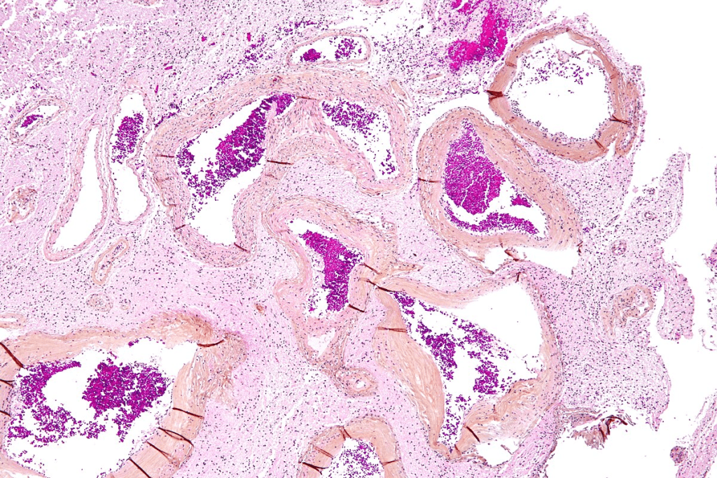 Angiodysplasia: 5 Critical Facts About This Serious Colon Condition You Must Know