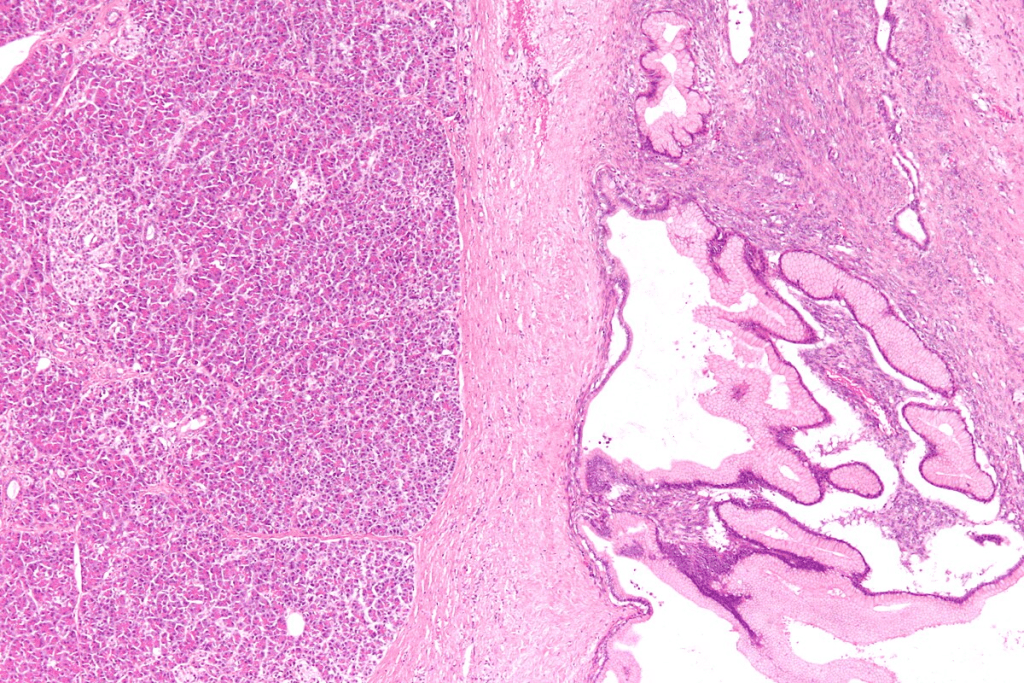 Cobb Syndrome AVM: Important Facts to Know 3 Cobb Syndrome AVM: Important Facts to Know