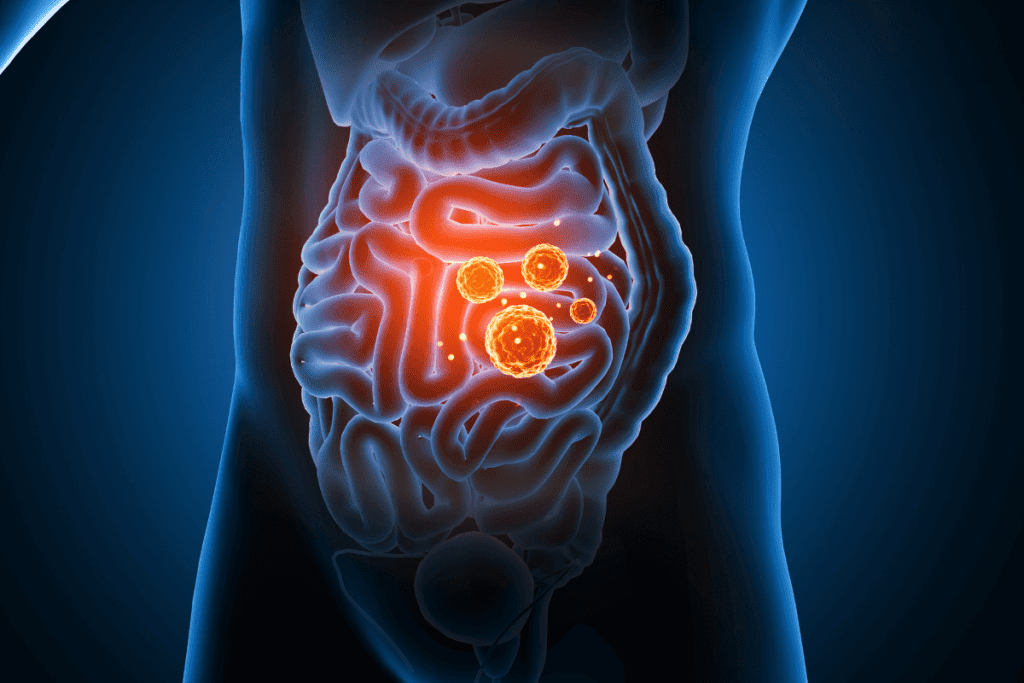 AVM: Understanding the Shocking Facts About GI Arteriovenous Malformation