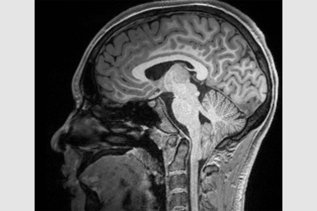 Chiari Malformation: 5 Key Facts About the Most Common Type Clearly Explained for Better Hope