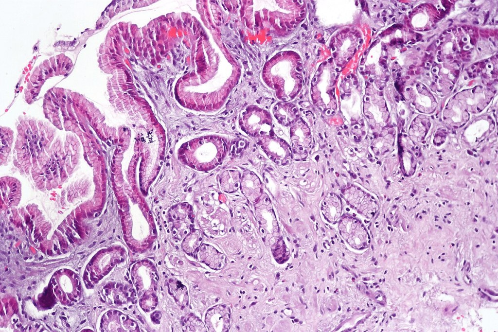 Gastrointestinal Amyloidosis: What to Know