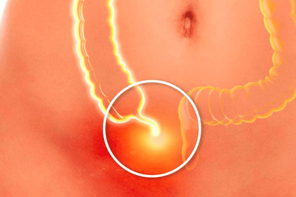 Appendicitis Symptoms: Know the Urgent Timeline