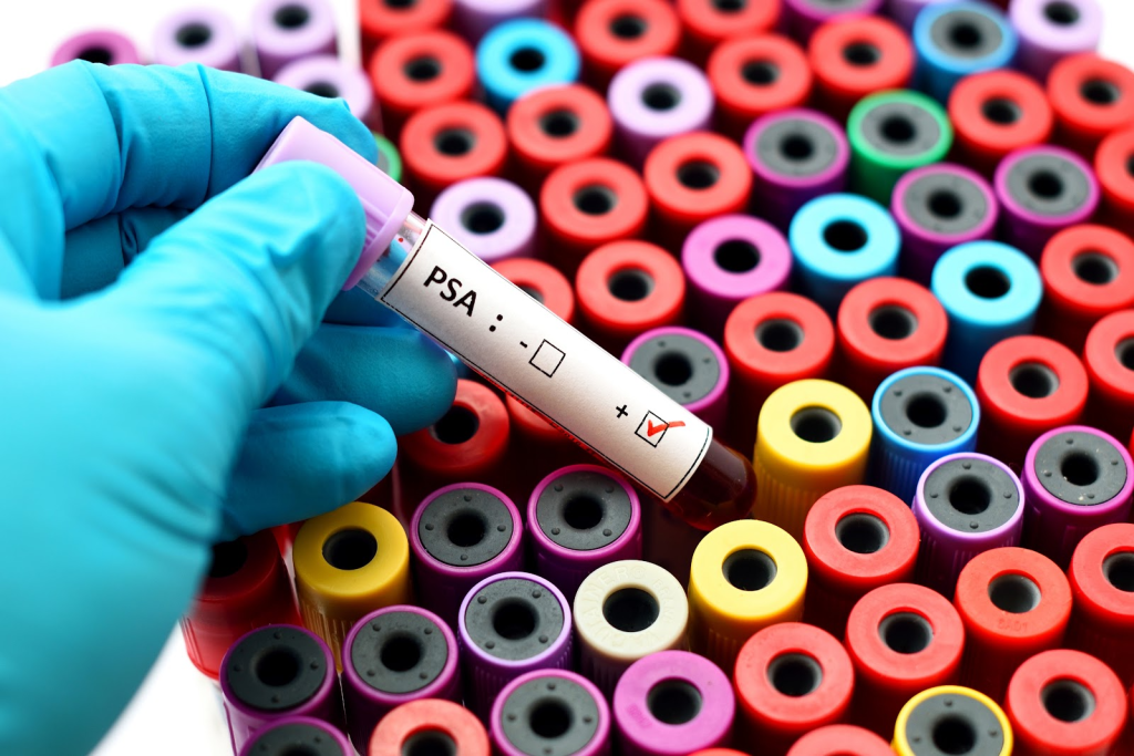 How to Lower PSA Levels: Amazing Quick Solutions