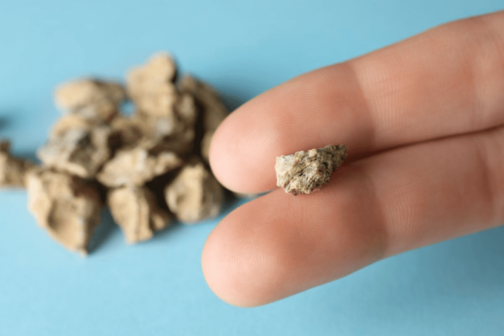Kidney Stone Removal: Find the Safest Best Method