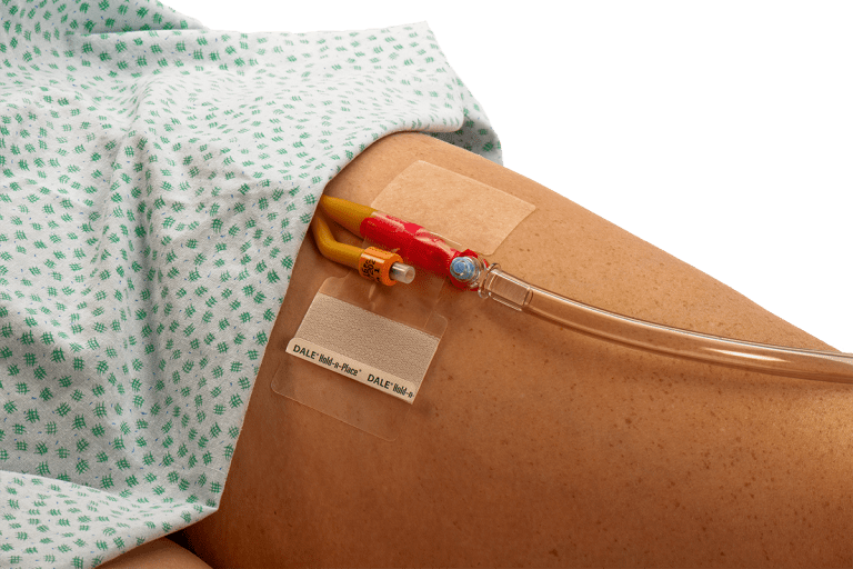 Suprapubic Catheterization: Crucial Reasons for Surgery