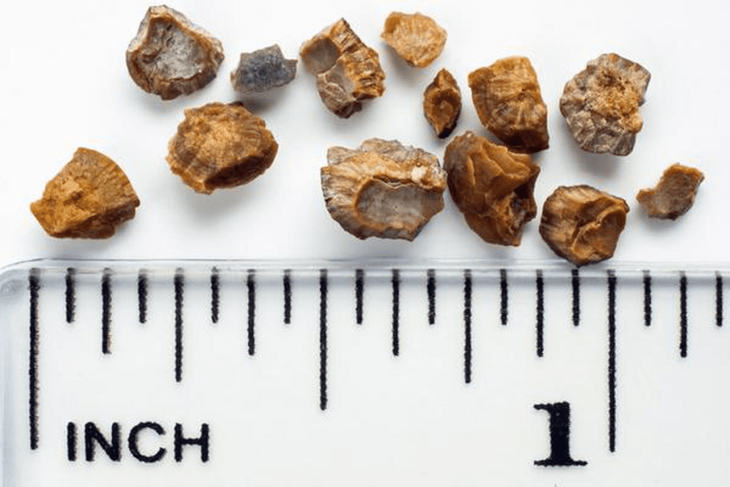 Kidney Stone Size: When is Surgery Absolutely Needed?
