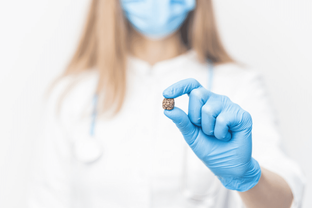 7mm Stone Size: Is Surgery Absolutely Needed?