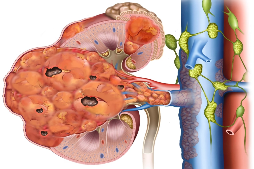 Ruptured Kidney: Understand Serious Symptoms & Care