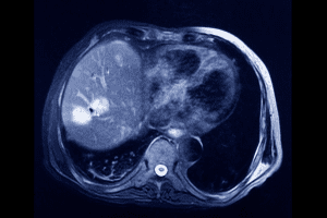 Does A CT Scan Detect Tumors? The Ultimate Bladder Cancer Fact
