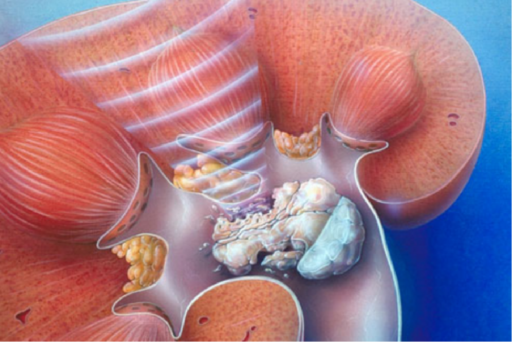 How to Get Rid of Kidney Stones: Fast Dissolvers