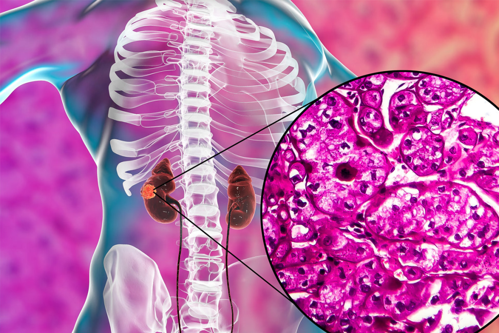 Kidney Cancer Symptoms: Crucial Five Warning Signs