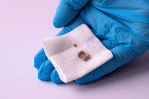 Lithotripsy: Crucial Expectations for ESWL Day