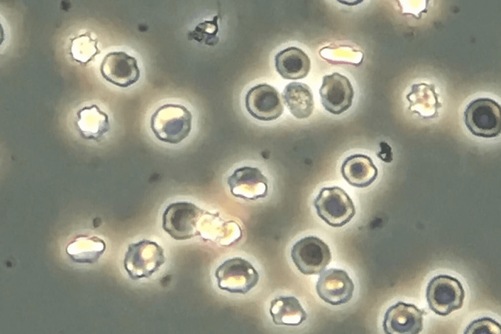 Bladder Cancer Symptoms: Negative Pain Facts