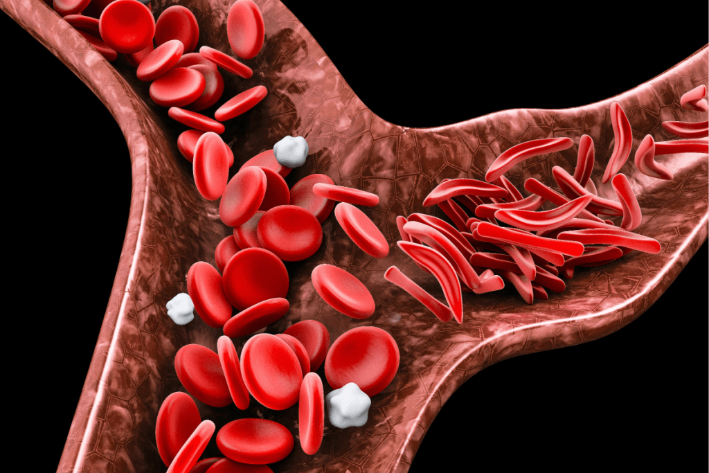 Immediate Sickle Cell Crisis: Crucial Steps to Calm Down
