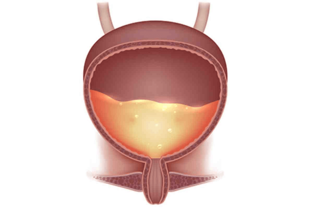 Neurogenic Bladder: Crucial 4 Best Types Explained 2 Neurogenic Bladder: Crucial 4 Types Explained